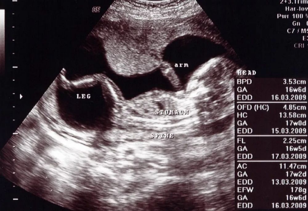 17 Week Ultrasound: What to Expect and What It Can Reveal