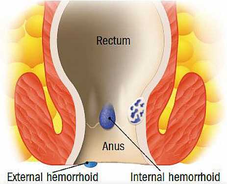 Bumps on Anus: Causes, Symptoms, and Treatment