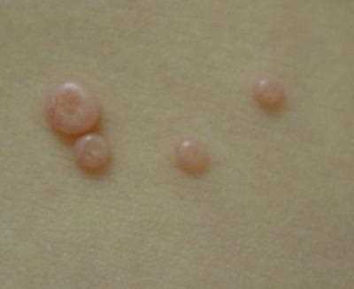 Causes and Treatment of White Clogged Pores Around the Anus | [Your ]