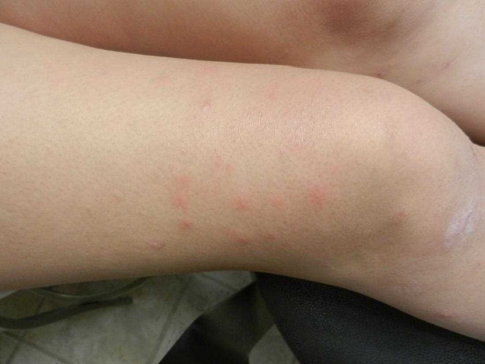 Causes, Treatment, and Prevention of Pimple on Leg: Everything You Need to Know