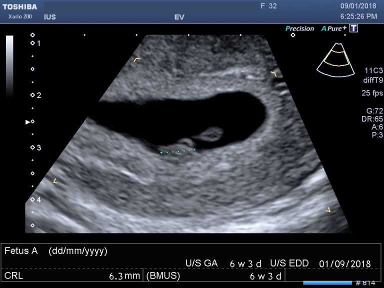 Everything You Need to Know About Your 25 Week Ultrasound: A Comprehensive Guide