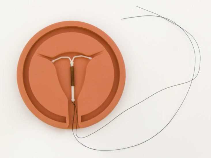 Exploring the Benefits of IUDs in Treating Endometriosis