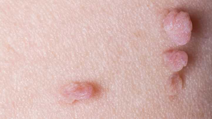 Skin Tags During Pregnancy: Causes, Treatment, and Prevention