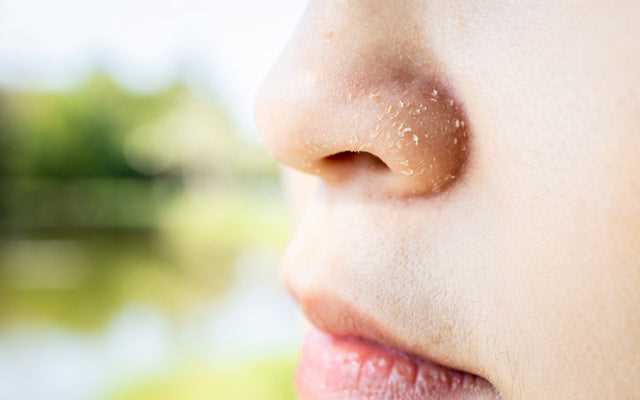 Red around the nose: Causes, Symptoms, and Treatment
