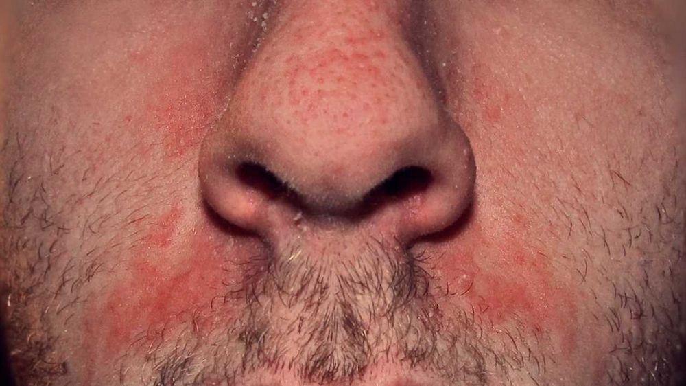 Red around the nose: Causes, Symptoms, and Treatment