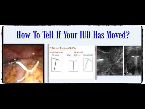 Signs Your IUD is Out of Place: How to Recognize the Symptoms