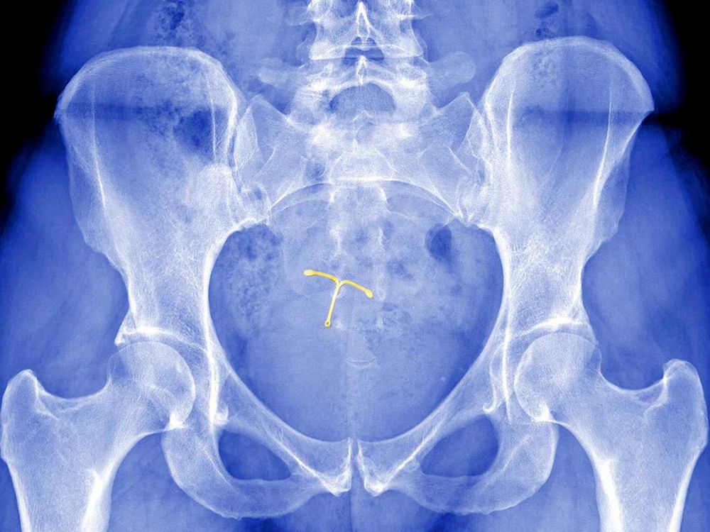 Signs Your IUD is Out of Place: How to Recognize the Symptoms