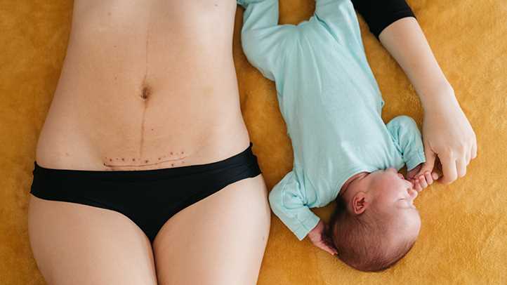 Stomach After C-Section vs Natural Birth: What to Expect and How to Recover