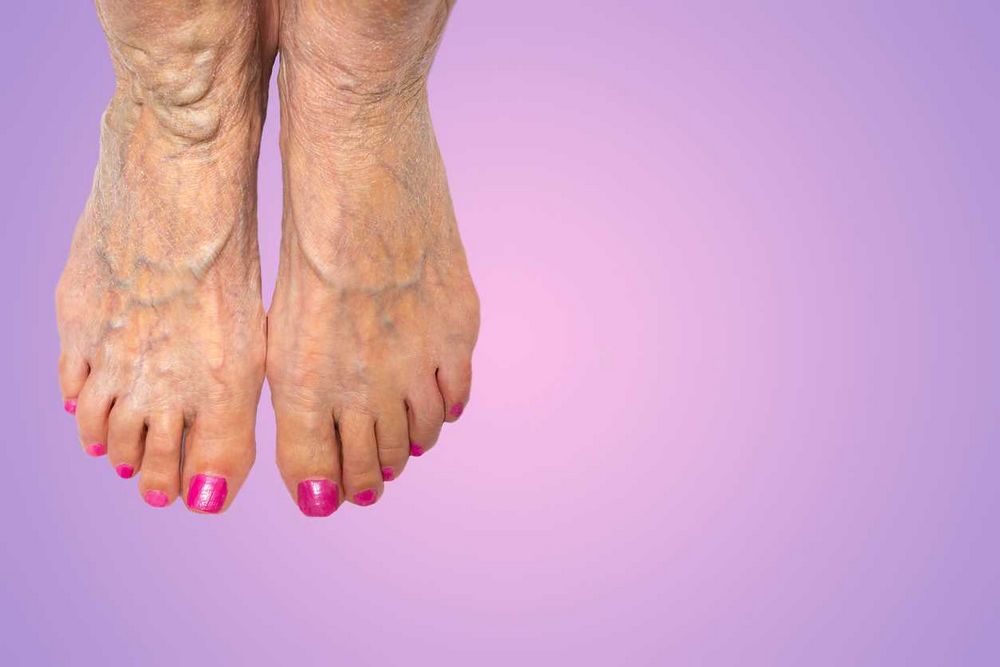 Sudden Bulging Veins on Top of Feet: Causes, Symptoms, and Treatment