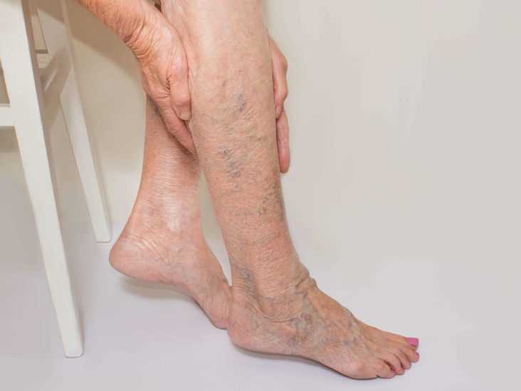 Sudden Bulging Veins on Top of Feet: Causes, Symptoms, and Treatment