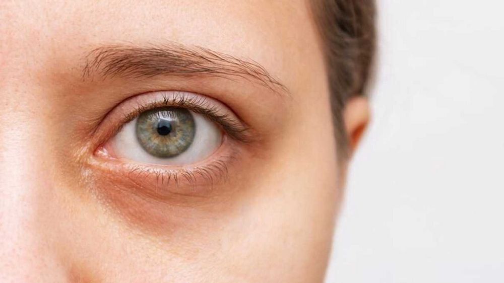 Sunken Eyes Dehydration: Causes, Symptoms, and Treatment