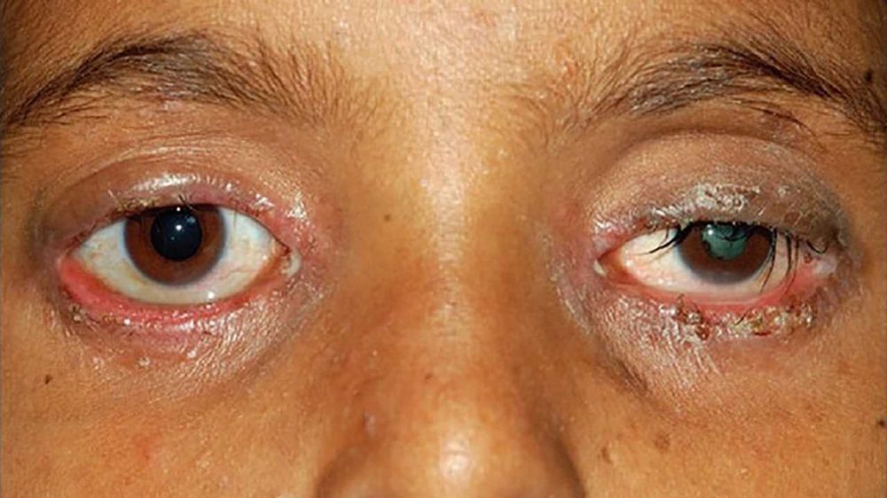 Toddler Eyes Stuck Together in the Morning: Causes, Treatment, and Prevention