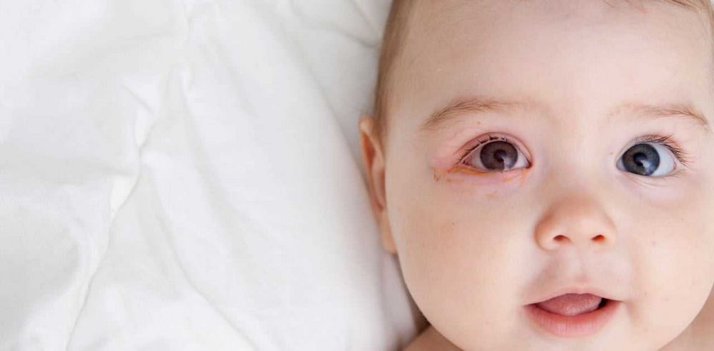 Toddler Eyes Stuck Together in the Morning: Causes, Treatment, and Prevention