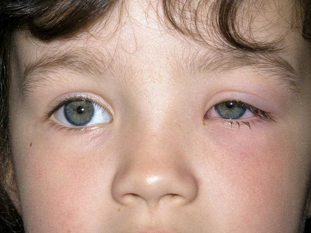 Toddler Swollen Eyelid: Causes, Symptoms, and Treatment