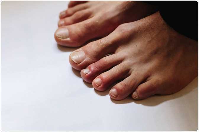 Toes Discoloration: Causes, Symptoms, and Treatment