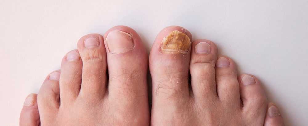 Toes Discoloration: Causes, Symptoms, and Treatment