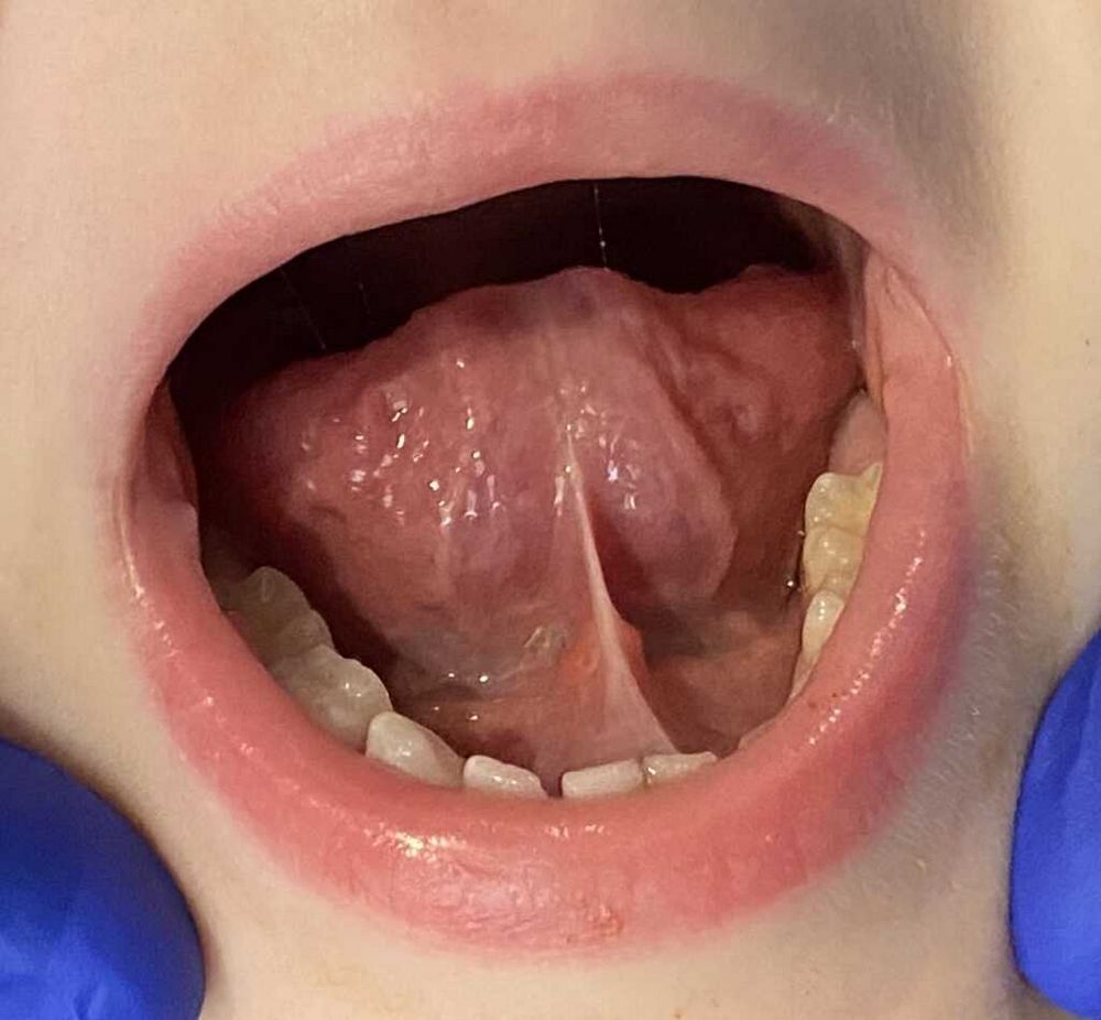Tongue-tie pictures in newborns: What to look for and how to treat
