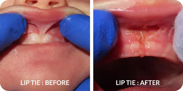 Tongue-tie pictures in newborns: What to look for and how to treat