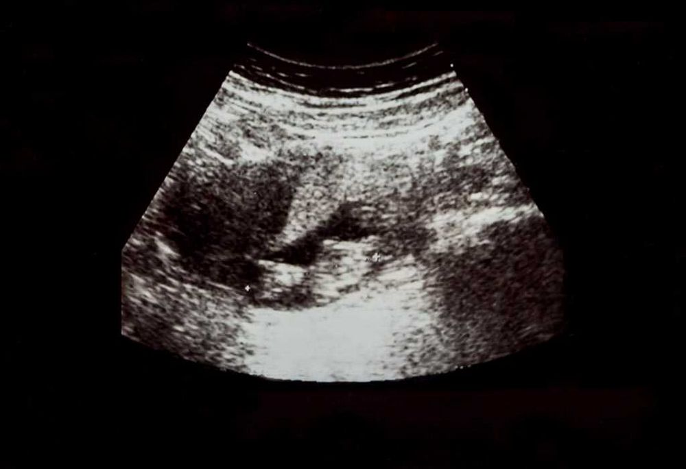 Twin Ultrasound at 9 Weeks: What to Expect and How to Prepare