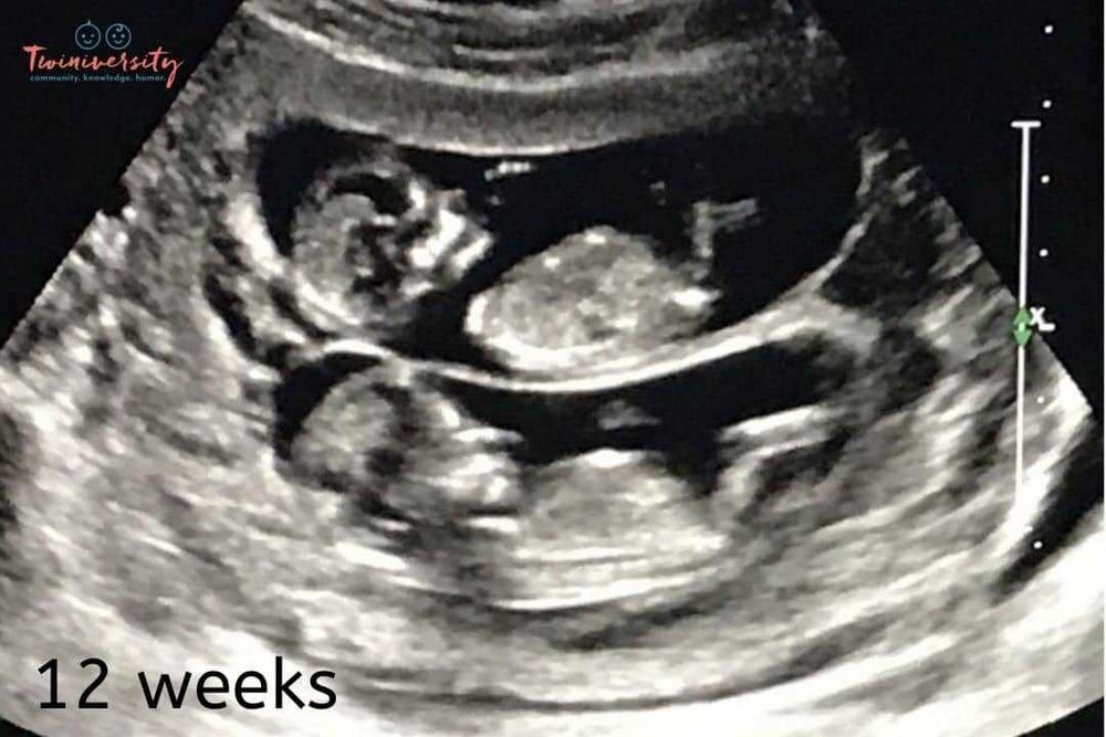 Twin Ultrasound: Everything You Need to Know - Complete Guide
