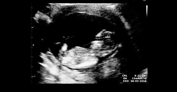 Ultrasound of Twins at 12 Weeks: What to Expect and How to Prepare