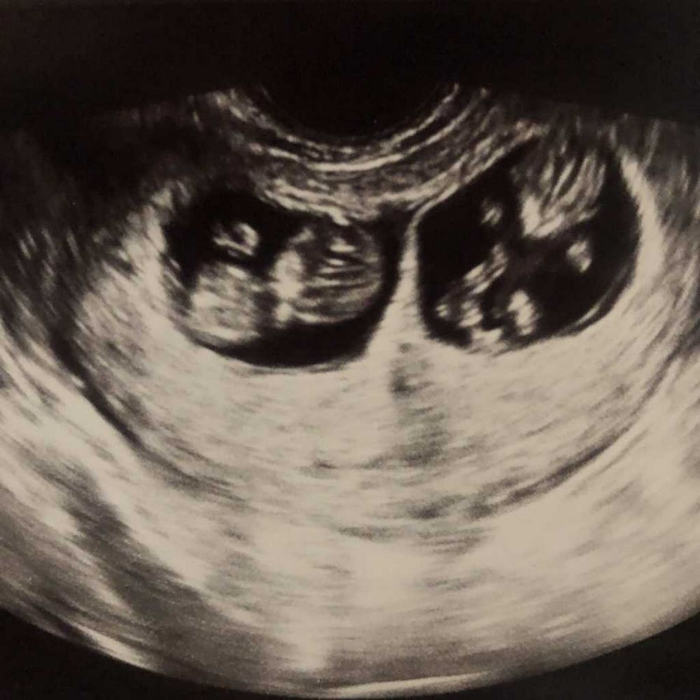 Ultrasound Triplets: Everything You Need to Know
